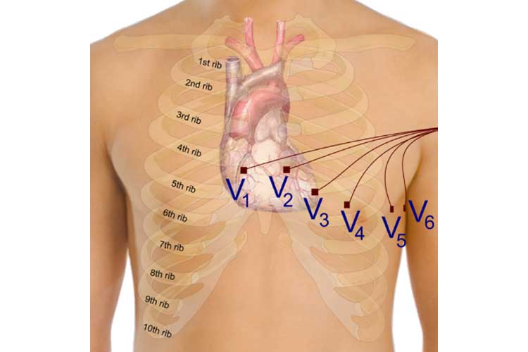 Precordial Electrodes - ECG Lead Placement - 12 Lead Placement